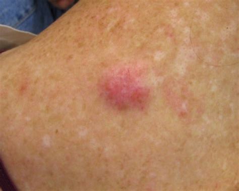 Leiomyosarcoma