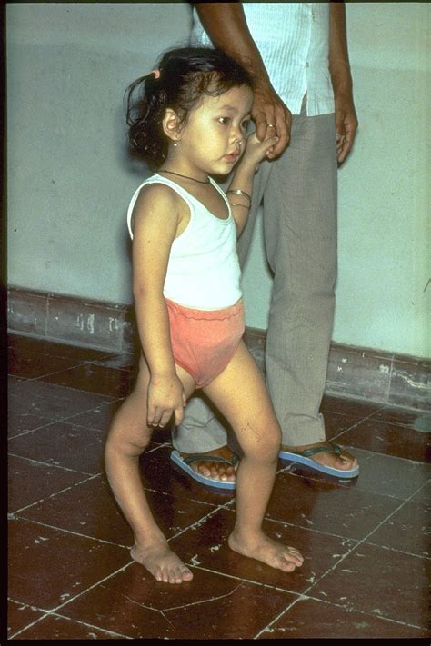 Polio Images | Immunize.org