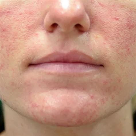 Rosacea – reviveclinic.nl