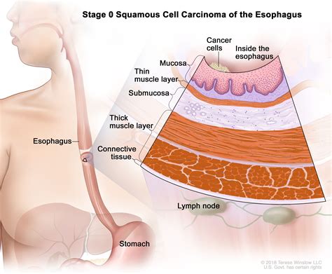 Esophageal Cancer Treatment (PDQ®) - NCI