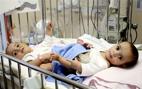Random Exploration: Conjoined twins, Omphalopagus, joined twins