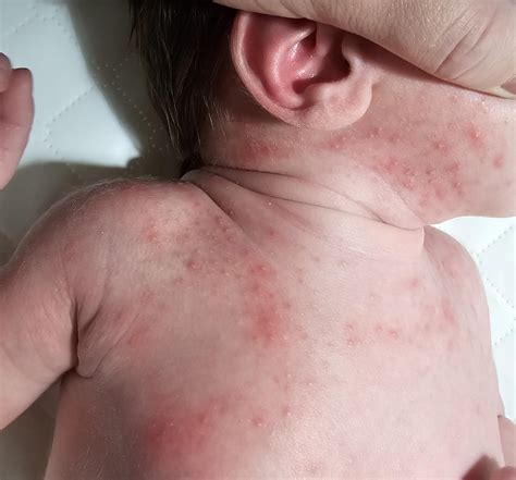 Erupção Cutânea Em Bebe - Erupcao Cutanea Em Bebes Foto De Bebê Com Uma Erupção Cutânea E