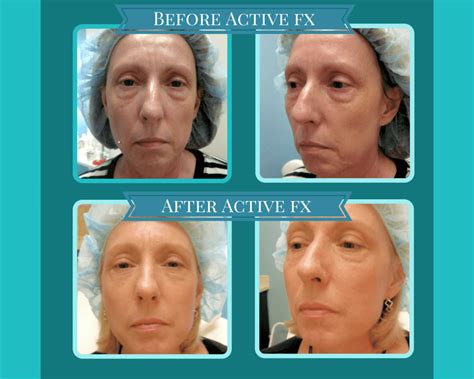 erase  impact  skin damage  active fx laser resurfacing