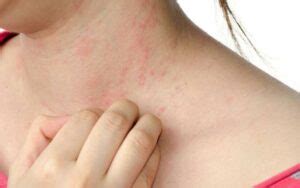 How to Get Rid of a Skin Rash: 14 Natural Remedies