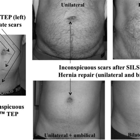 Single-incision laparoscopic inguinal hernia repair with or without ...