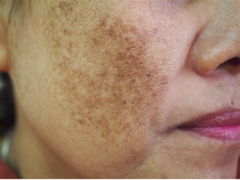 skin condition called melasma  john heidt blog