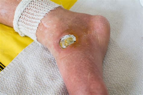 Diabetic Foot Ulcer