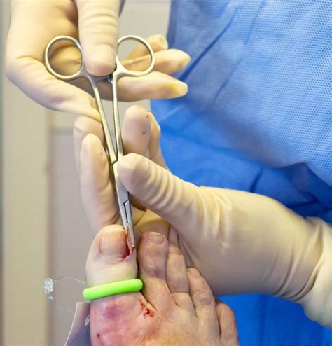 Our Highly Trained Podiatrist Can Perform Ingrown Toenail Surgery