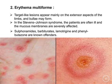 Drug Induced Skin Disorders | PPT