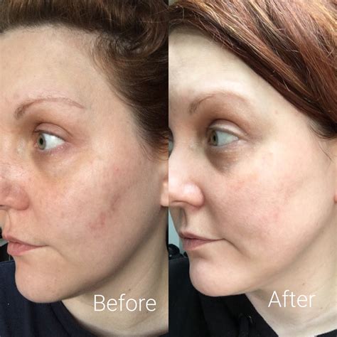 Vitamin C Supplement For Skin Before And After - VITAMIN C - The Secret ...