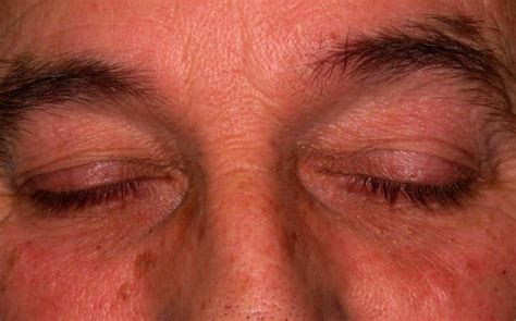 Treatment for lump inside eyelid, chalazion, eyelid cyst | Mr David Cheung | Eyelid Specialist