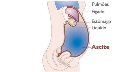 Água Na Barriga E Grave - Como Acabar com a Barriga d’Água: Principais Formas | Dr. Saúde