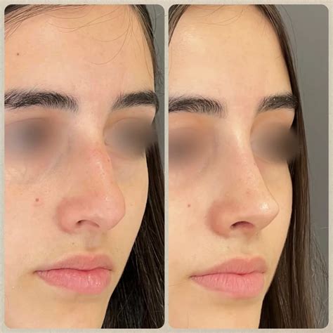Rinoplastia Preço Antes E Depois - Rinoplastia Antes e Depois - Técnica Preservadora - Dr Luis Felipe Athayde
