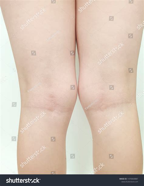 Knee Deformation Problem Stock Photo 1470069887 | Shutterstock