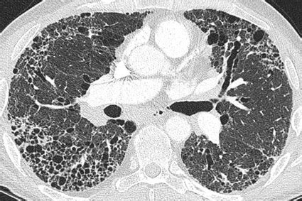 Promising steps towards a treatment for pulmonary fibrosis