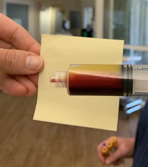 patient   blood tg level   rmedicine