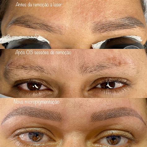 Remoção De Sobrancelha A Laser - Remoção a laser - Simone Barros