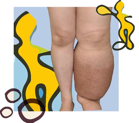 Linfedema – Agadelprise