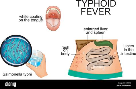 Salmonella Rash On Face - jhayrshow