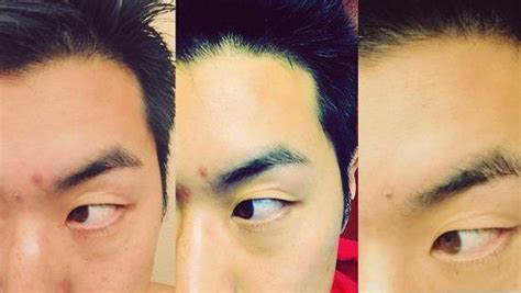 how to heal an open pimple wound