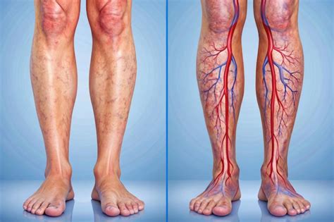 Comparison of normal leg veins and those affected by venous conditions ...