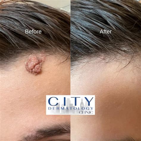 wart removal  london  ps  day treatment