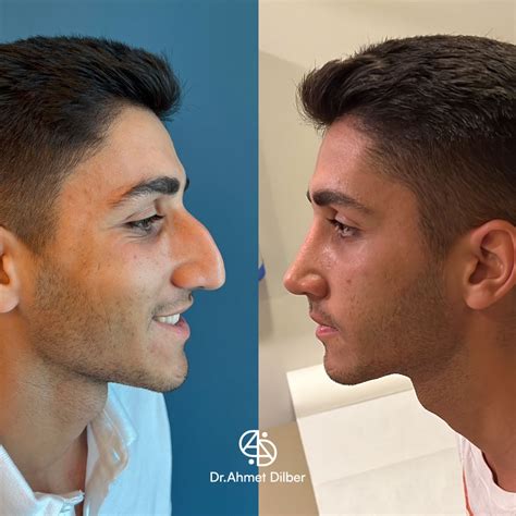 Rinoplastia Antes E Depois Homem