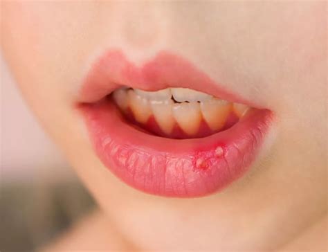 Как лечить стоматит у детей – статьи детской стоматологической клиники ...