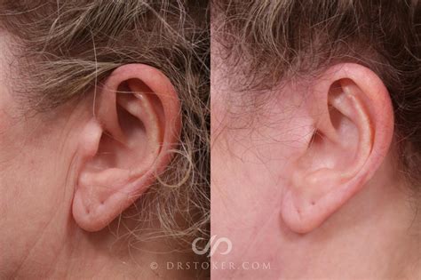 Facelift Incisions (Hidden Scars) Before and After Photo Gallery | Los