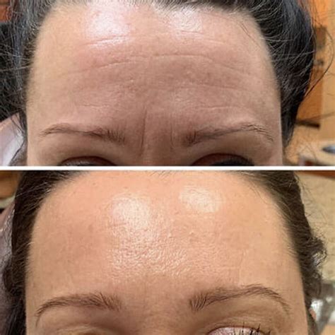 botox perfect touch medspa