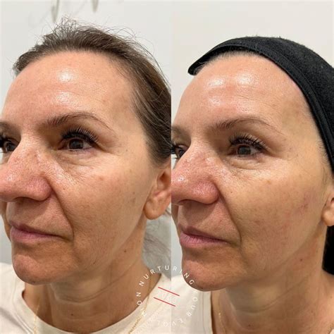 Skin Tightening Treatment Sydney | Laser Skin Tightening | ELC