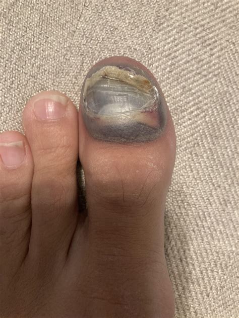 Hematoma Toenail Subungual Hematoma