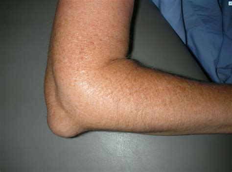 Olecranon Bursitis – Dr. Edward Weldon