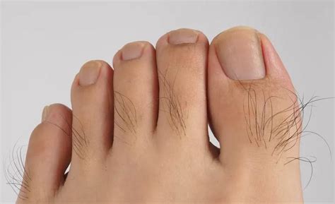 3 Reasons for Hairy Toes and 7 Methods to Treat Them