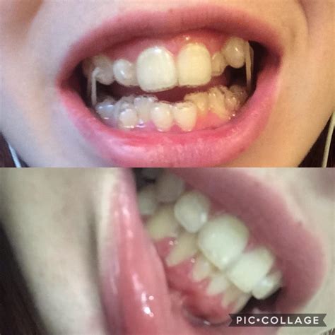 Invisalign Retainer Vs Night Guard at George Maple blog