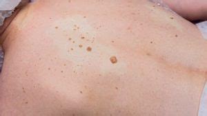 How to Remove Seborrheic Keratosis at Home: Safe and Effective Methods ...