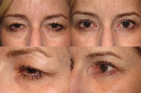 Upper Blepharoplasty Before After