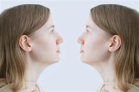 surgical solutions   hooked nose becker rhinoplasty center