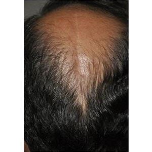 scalp reduction  hair transplant result gallery