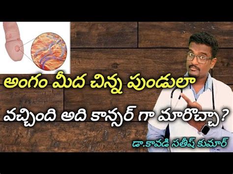 penis infection  change penile cancer  telugu doctor satheesh
