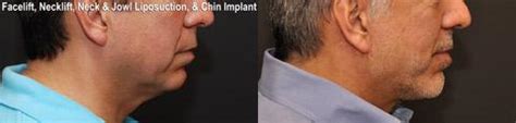 The Complete Guide to Chin Implant Recovery