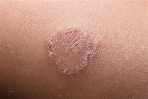 Ringworm (Tinea Corporis) - Katu Dermatology Clinic