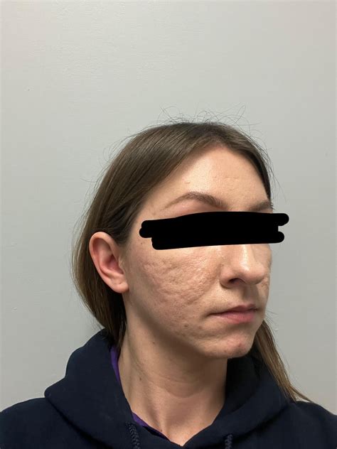 Severe scarring. Any acne specialists/scar specialists in Arizona