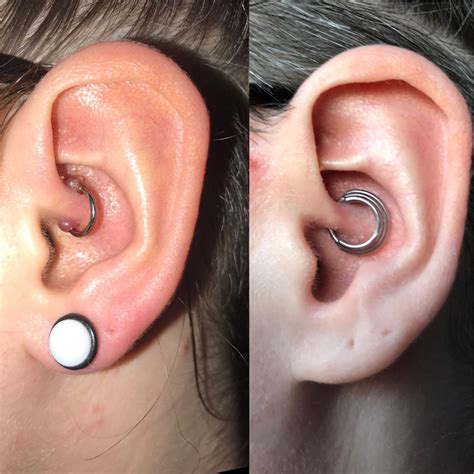 Hypertrophic Scar Treatment Nose Piercing at Will Cornish blog