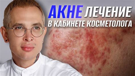 АКНЕ ЛЕЧЕНИЕ в кабинете косметолога | Роаккутан Сотрет опасность #акне ...