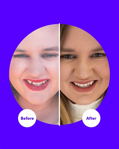 Smile Direct Club