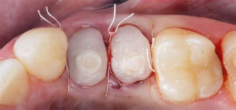 exposed dentin signs symptoms  treatments