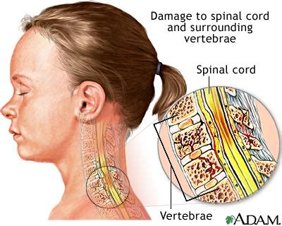 Responding to a Cervical Spinal Cord Injury - INSYNC PHYSIO