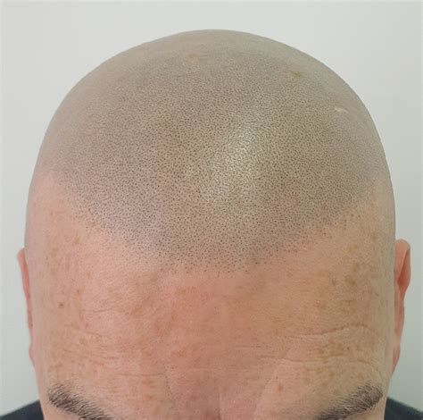 scalp micropigmentation  wrong skalp