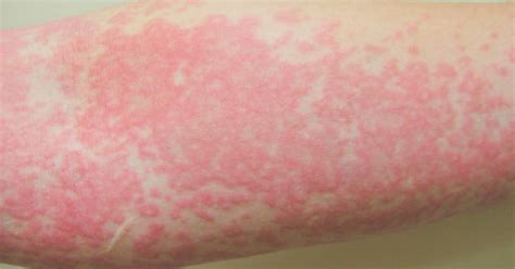 Dr Medico Allergic Reaction Skin Rash Treatment - vrogue.co